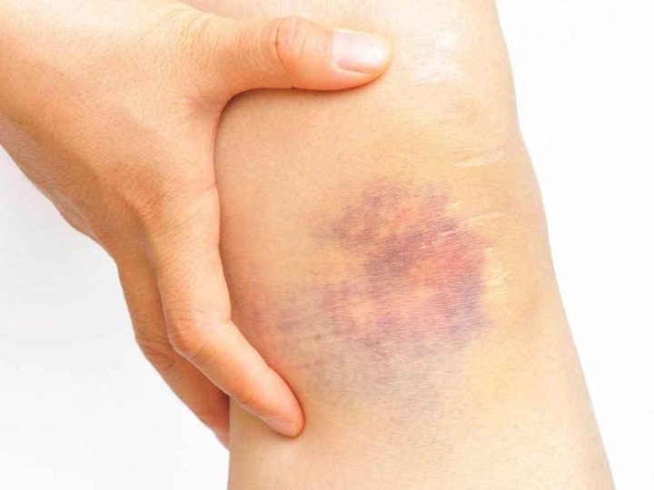 How to Treat and Heal a Bruise