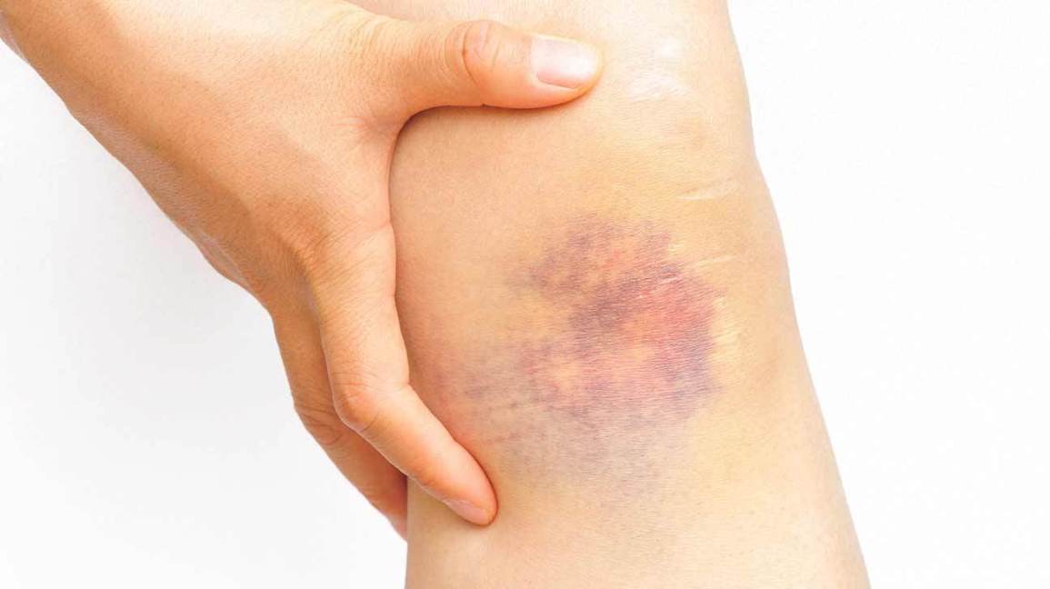 How to Treat and Heal a Bruise